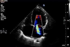 UFS cardiac team does pioneering work
